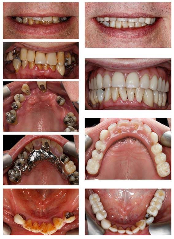 gum diease