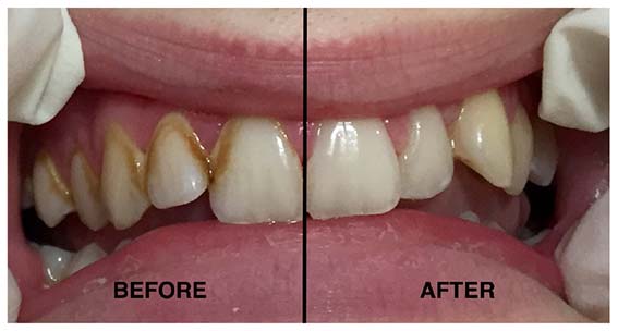 teeth whitening