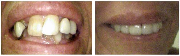 teeth bridge crown