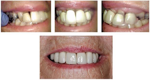 tooth crowns