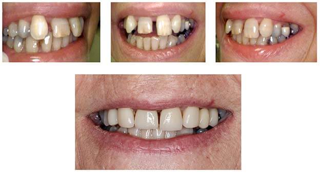 veneers