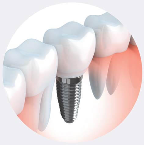 tooth implants