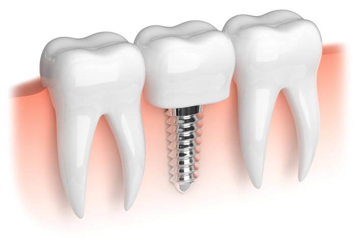 tooth implants suffolk