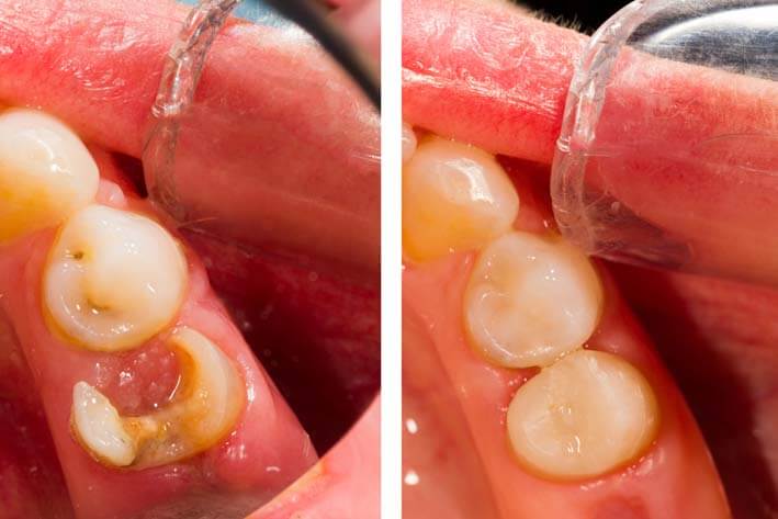 root canal fillings ipswich